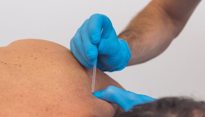 Puncion seca Fisioterapia